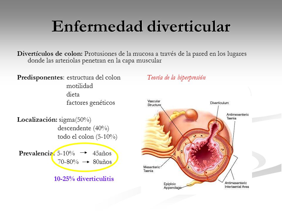 Enfermedad diverticular del colon dieta Enfermedad diverticular del colon dieta